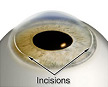 Astigmatism Correction Incisions