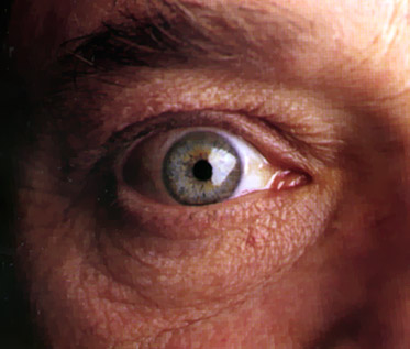 Dry Eye